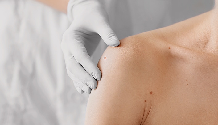 Stock photograph of models: a gloved hand examines small moles on a bare shoulder